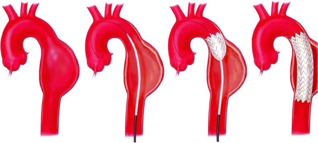 Aorta TEVAR
