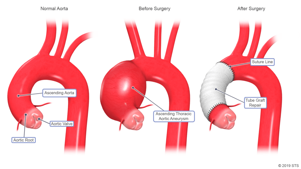 Ascending Aneurysm Repair