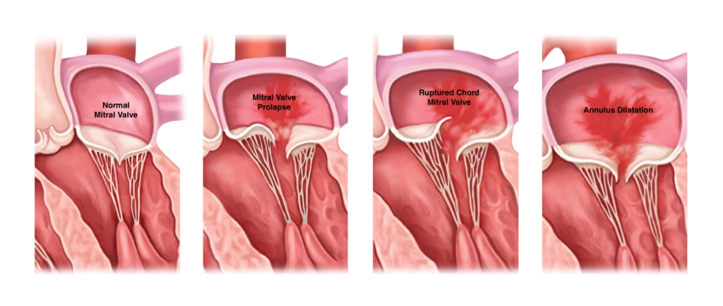 Mitral Regurgitation