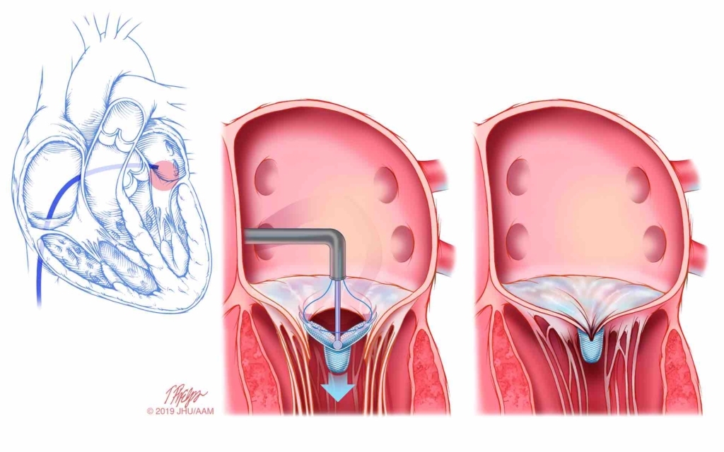 Mitral clip
