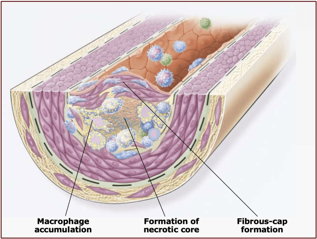 Atherosclerosis late