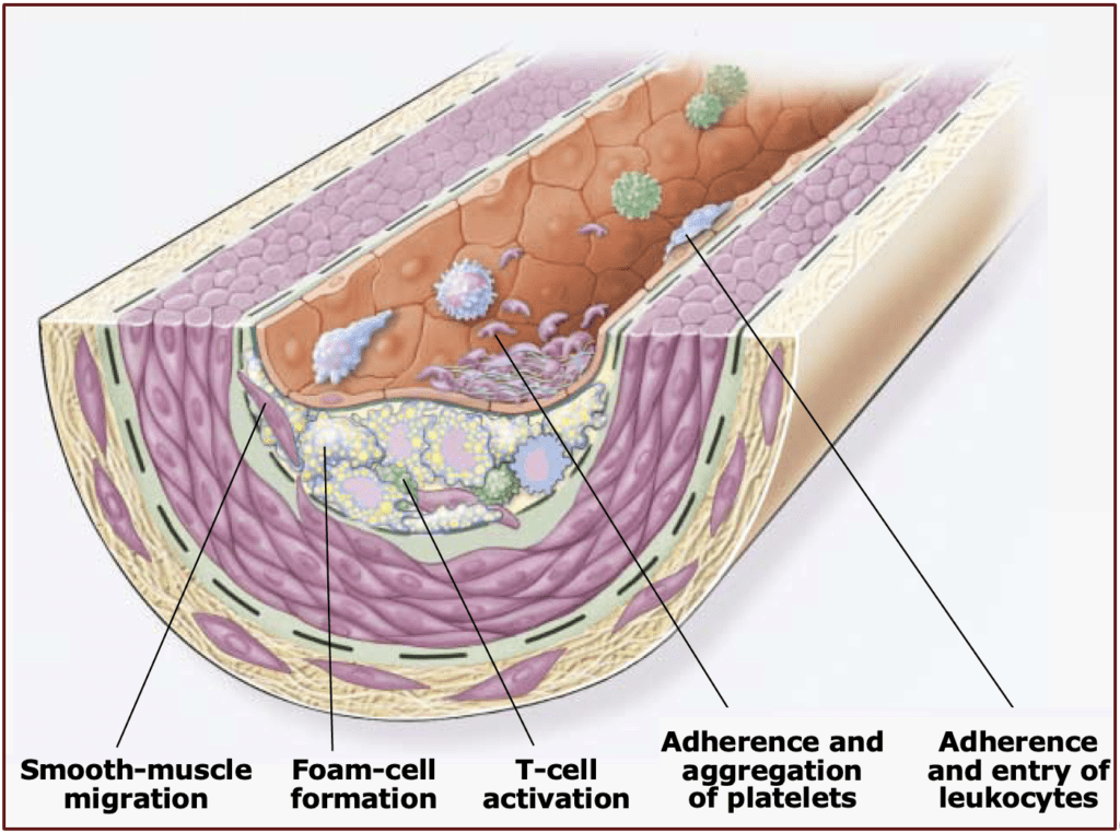 Atherosclerosis middle