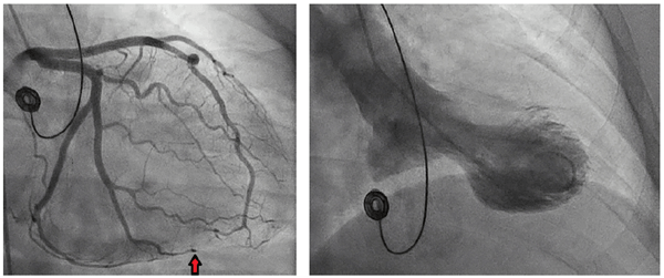 Takotsubo Cath Images