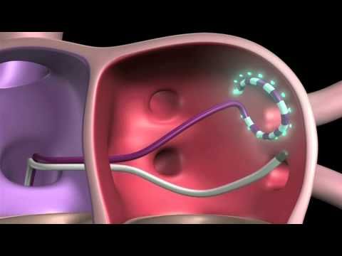 Afib ablation