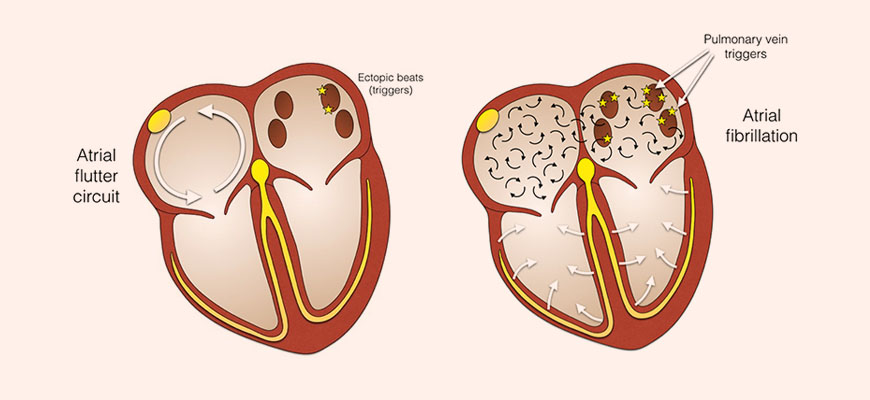 Afib and aflutter