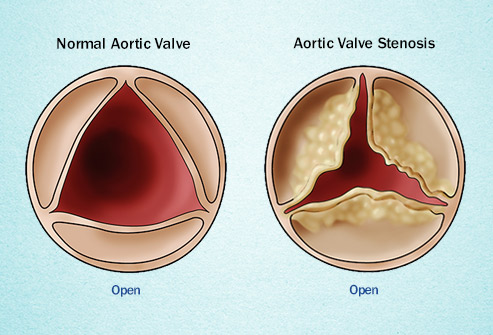 Aortic stenosis