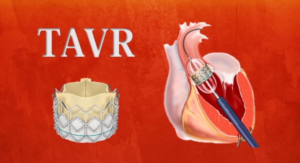 TAVR